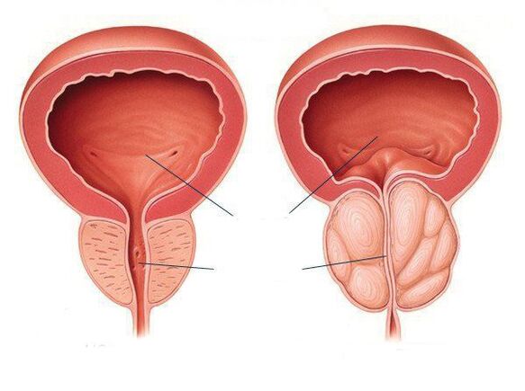 Simptome giardia netratata diagnosticul diferențial al prostatitei acute