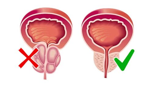 prostata prije i nakon primjene Prostalina