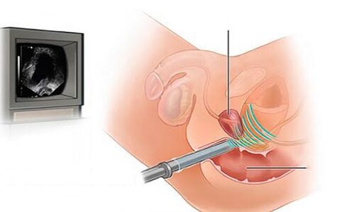 ultrazvuk prostate